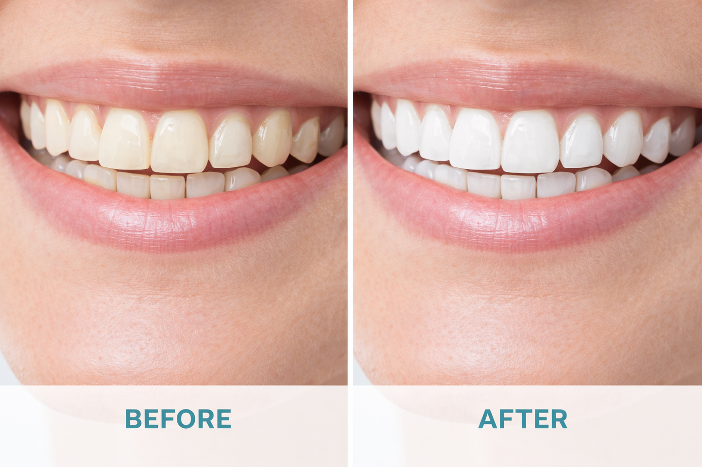 GLOAURA Premium Teeth Whitening Strips – Hawaiian Edition (14 Strips)