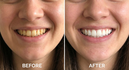 Meansmile Professional Whitening Strips with Coconut Oil & No Mess Formula